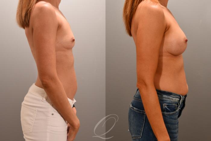 Breast Augmentation Case 1001706 Before & After Right Side | Serving Rochester, Syracuse & Buffalo, NY | Quatela Center for Plastic Surgery