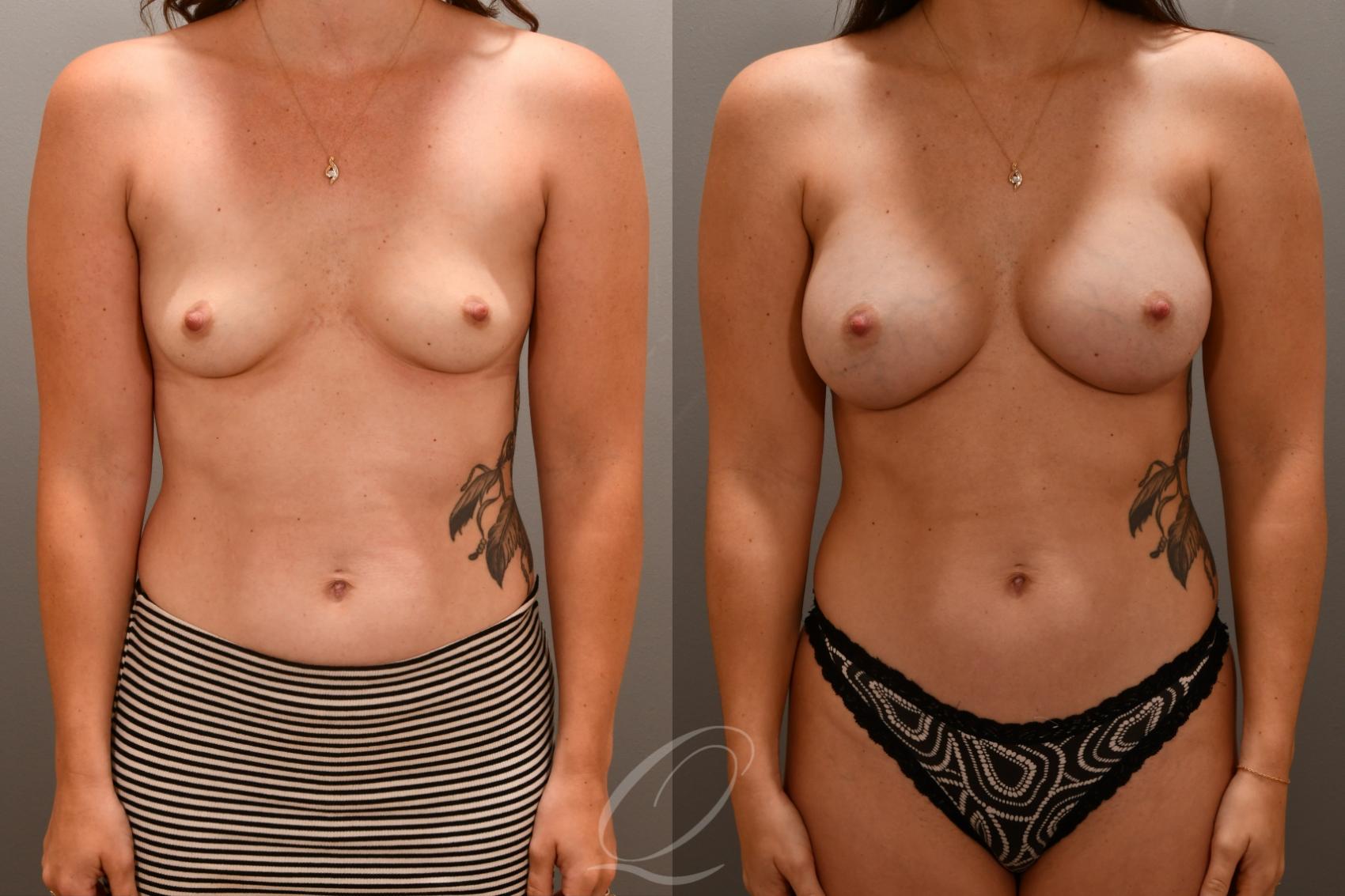 Breast Augmentation Case 1001714 Before & After Front | Serving Rochester, Syracuse & Buffalo, NY | Quatela Center for Plastic Surgery