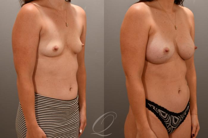 Breast Augmentation Case 1001714 Before & After Right Oblique | Serving Rochester, Syracuse & Buffalo, NY | Quatela Center for Plastic Surgery