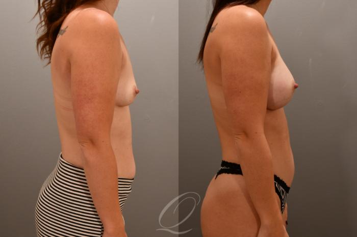 Breast Augmentation Case 1001714 Before & After Right Side | Serving Rochester, Syracuse & Buffalo, NY | Quatela Center for Plastic Surgery