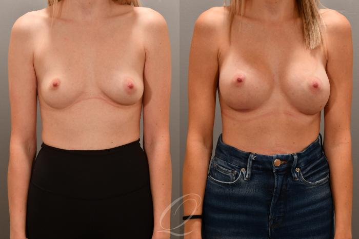 Breast Augmentation Case 1001715 Before & After Front | Serving Rochester, Syracuse & Buffalo, NY | Quatela Center for Plastic Surgery