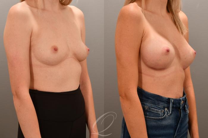 Breast Augmentation Case 1001715 Before & After Right Oblique | Serving Rochester, Syracuse & Buffalo, NY | Quatela Center for Plastic Surgery