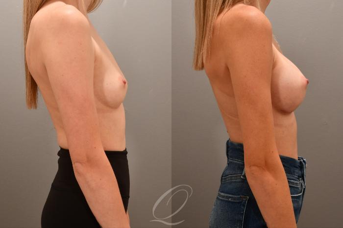 Breast Augmentation Case 1001715 Before & After Right Side | Serving Rochester, Syracuse & Buffalo, NY | Quatela Center for Plastic Surgery