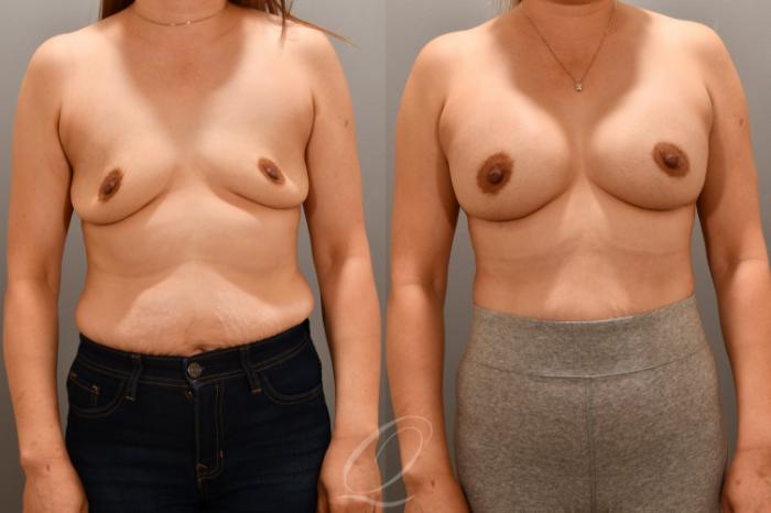 Breast Augmentation Case 1001716 Before & After Front | Serving Rochester, Syracuse & Buffalo, NY | Quatela Center for Plastic Surgery