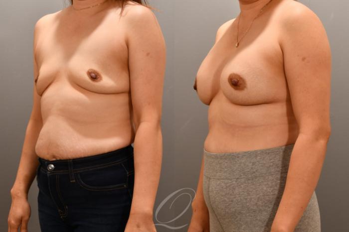 Breast Augmentation Case 1001716 Before & After Left Oblique | Serving Rochester, Syracuse & Buffalo, NY | Quatela Center for Plastic Surgery