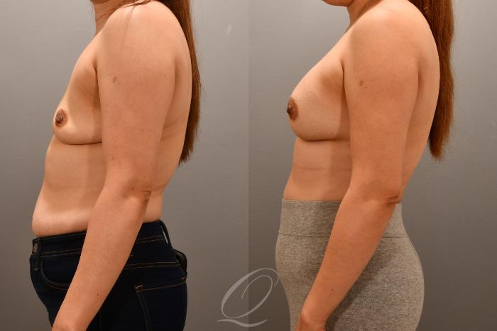 Breast Augmentation Case 1001716 Before & After Left Side | Serving Rochester, Syracuse & Buffalo, NY | Quatela Center for Plastic Surgery