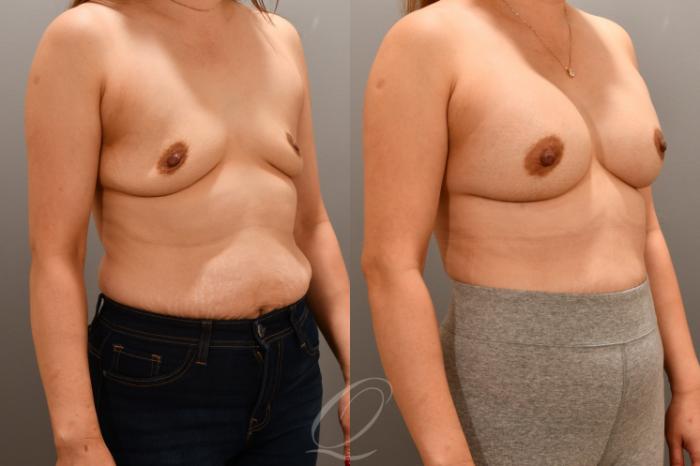 Breast Augmentation Case 1001716 Before & After Right Oblique | Serving Rochester, Syracuse & Buffalo, NY | Quatela Center for Plastic Surgery