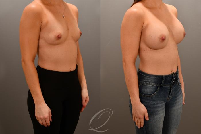 Breast Augmentation Case 1001740 Before & After Right Oblique | Serving Rochester, Syracuse & Buffalo, NY | Quatela Center for Plastic Surgery