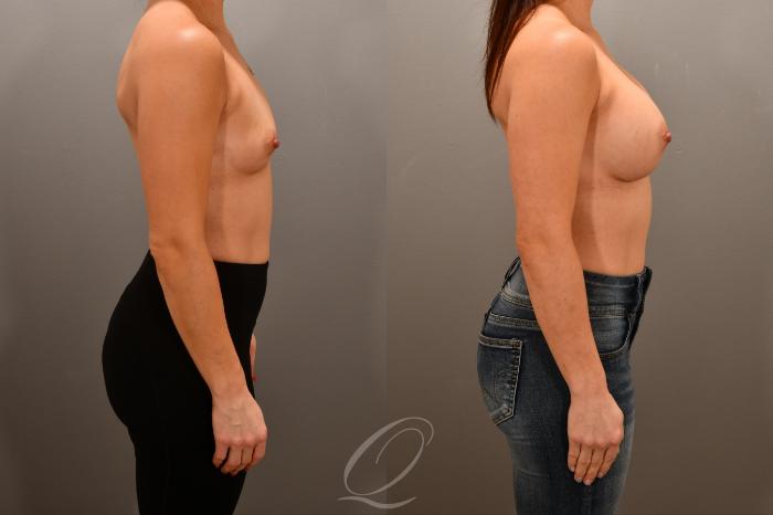 Breast Augmentation Case 1001740 Before & After Right Side | Serving Rochester, Syracuse & Buffalo, NY | Quatela Center for Plastic Surgery