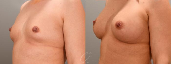 Breast Augmentation Case 1001763 Before & After Left Oblique | Serving Rochester, Syracuse & Buffalo, NY | Quatela Center for Plastic Surgery