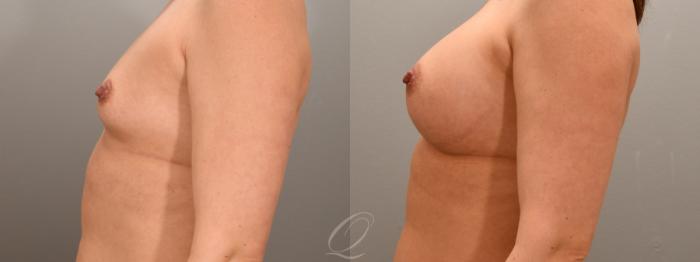 Breast Augmentation Case 1001763 Before & After Left Side | Serving Rochester, Syracuse & Buffalo, NY | Quatela Center for Plastic Surgery