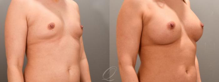 Breast Augmentation Case 1001763 Before & After Right Oblique | Serving Rochester, Syracuse & Buffalo, NY | Quatela Center for Plastic Surgery