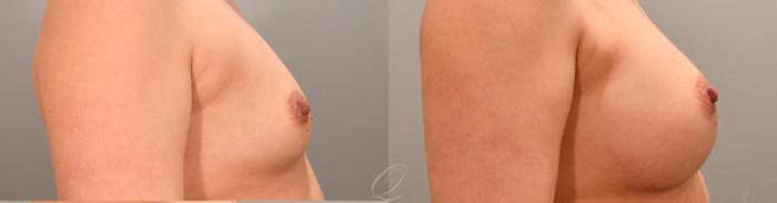 Breast Augmentation Case 1001763 Before & After Right Side | Serving Rochester, Syracuse & Buffalo, NY | Quatela Center for Plastic Surgery