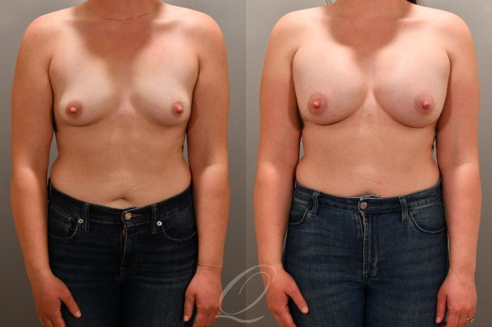 Breast Augmentation Case 1001764 Before & After Front | Serving Rochester, Syracuse & Buffalo, NY | Quatela Center for Plastic Surgery