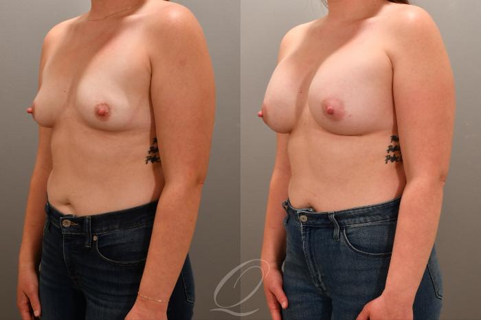 Breast Augmentation Case 1001764 Before & After Left Oblique | Serving Rochester, Syracuse & Buffalo, NY | Quatela Center for Plastic Surgery