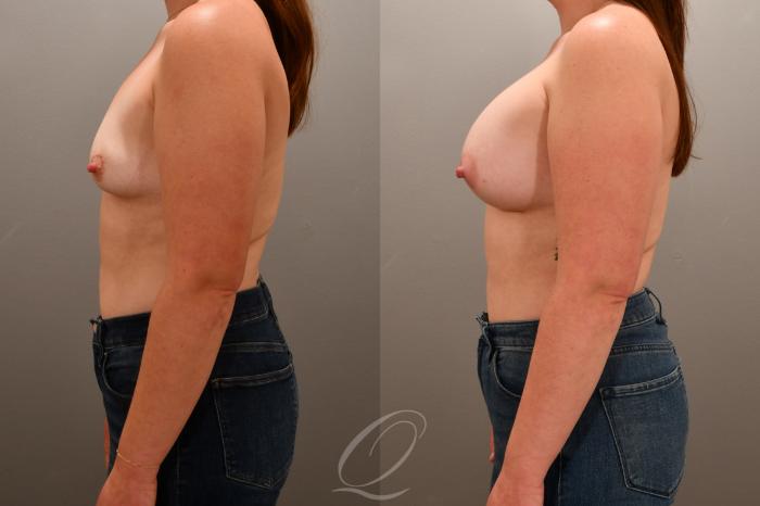 Breast Augmentation Case 1001764 Before & After Left Side | Serving Rochester, Syracuse & Buffalo, NY | Quatela Center for Plastic Surgery