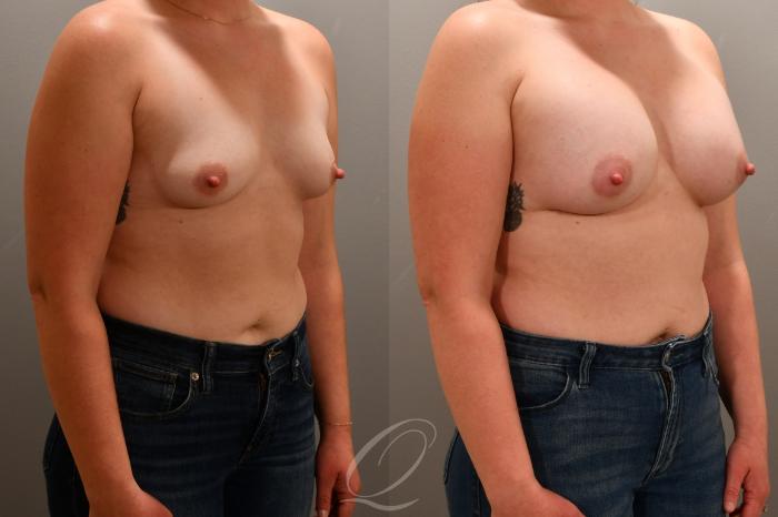 Breast Augmentation Case 1001764 Before & After Right Oblique | Serving Rochester, Syracuse & Buffalo, NY | Quatela Center for Plastic Surgery