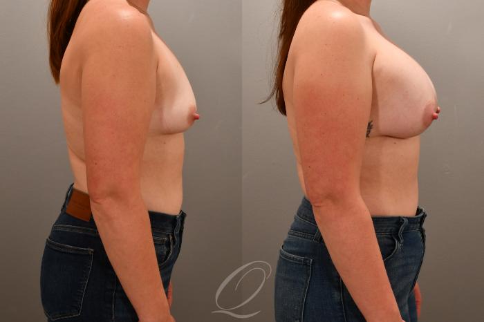 Breast Augmentation Case 1001764 Before & After Right Side | Serving Rochester, Syracuse & Buffalo, NY | Quatela Center for Plastic Surgery