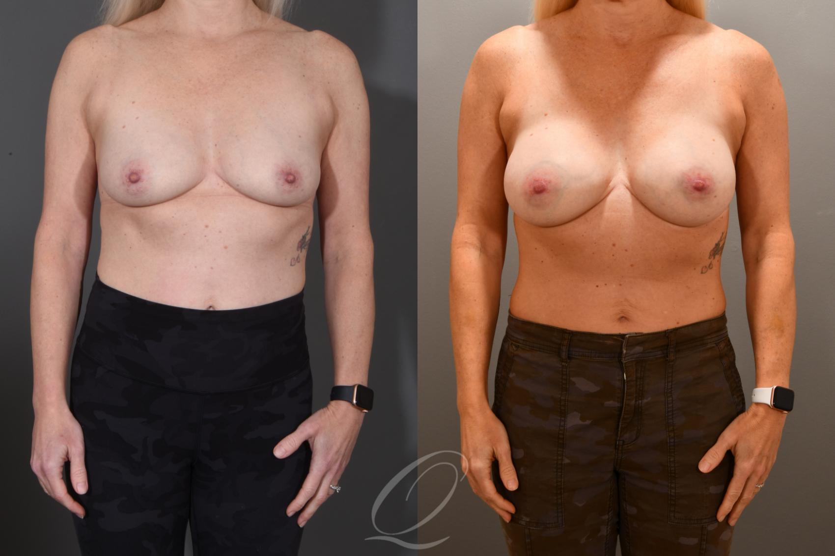 Breast Augmentation Case 1001795 Before & After Front | Serving Rochester, Syracuse & Buffalo, NY | Quatela Center for Plastic Surgery