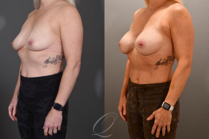 Breast Augmentation Case 1001795 Before & After Left Oblique | Serving Rochester, Syracuse & Buffalo, NY | Quatela Center for Plastic Surgery