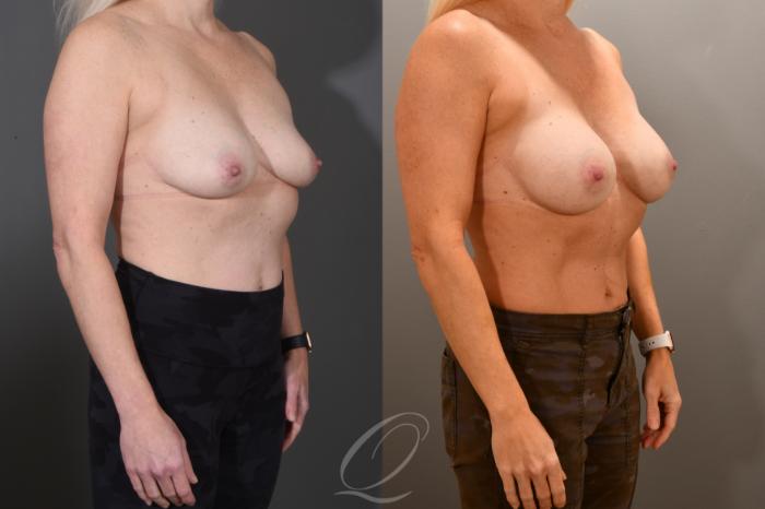 Breast Augmentation Case 1001795 Before & After Right Oblique | Serving Rochester, Syracuse & Buffalo, NY | Quatela Center for Plastic Surgery