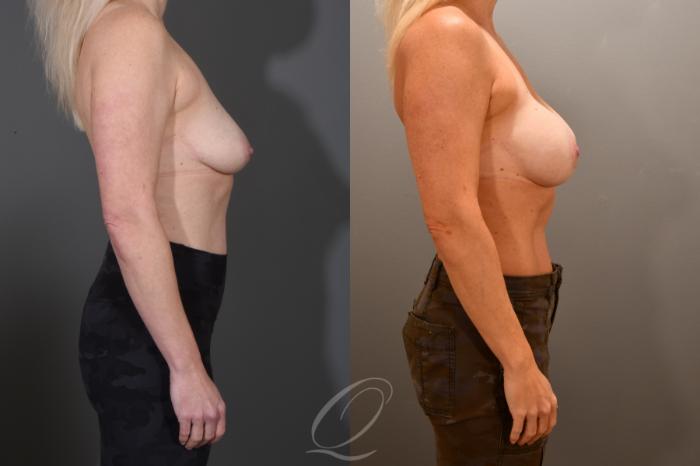 Breast Augmentation Case 1001795 Before & After Right Side | Serving Rochester, Syracuse & Buffalo, NY | Quatela Center for Plastic Surgery