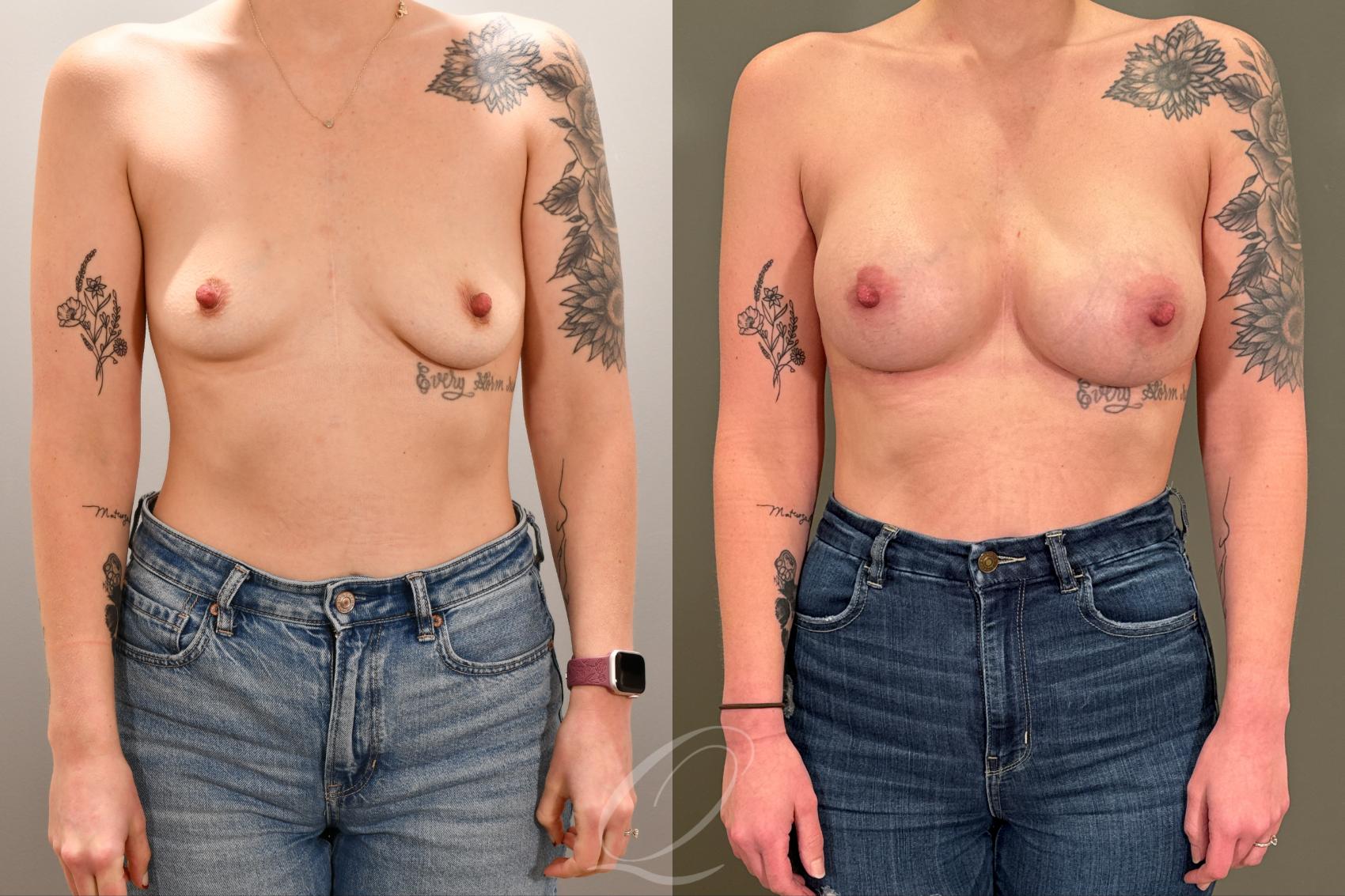 Breast Augmentation Case 1001801 Before & After Front | Serving Rochester, Syracuse & Buffalo, NY | Quatela Center for Plastic Surgery