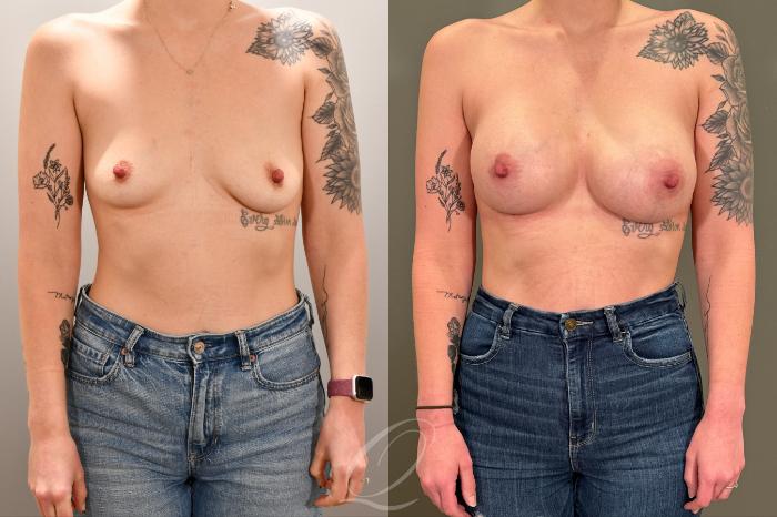 Breast Augmentation Case 1001801 Before & After Front | Serving Rochester, Syracuse & Buffalo, NY | Quatela Center for Plastic Surgery