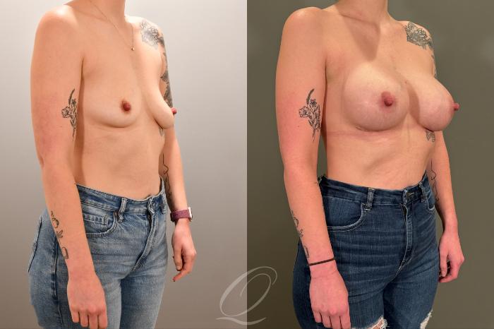 Breast Augmentation Case 1001801 Before & After Right Oblique | Serving Rochester, Syracuse & Buffalo, NY | Quatela Center for Plastic Surgery