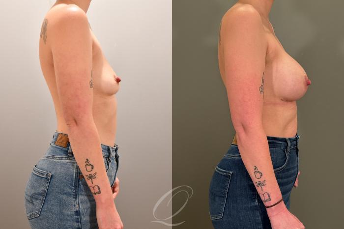 Breast Augmentation Case 1001801 Before & After Right Side | Serving Rochester, Syracuse & Buffalo, NY | Quatela Center for Plastic Surgery