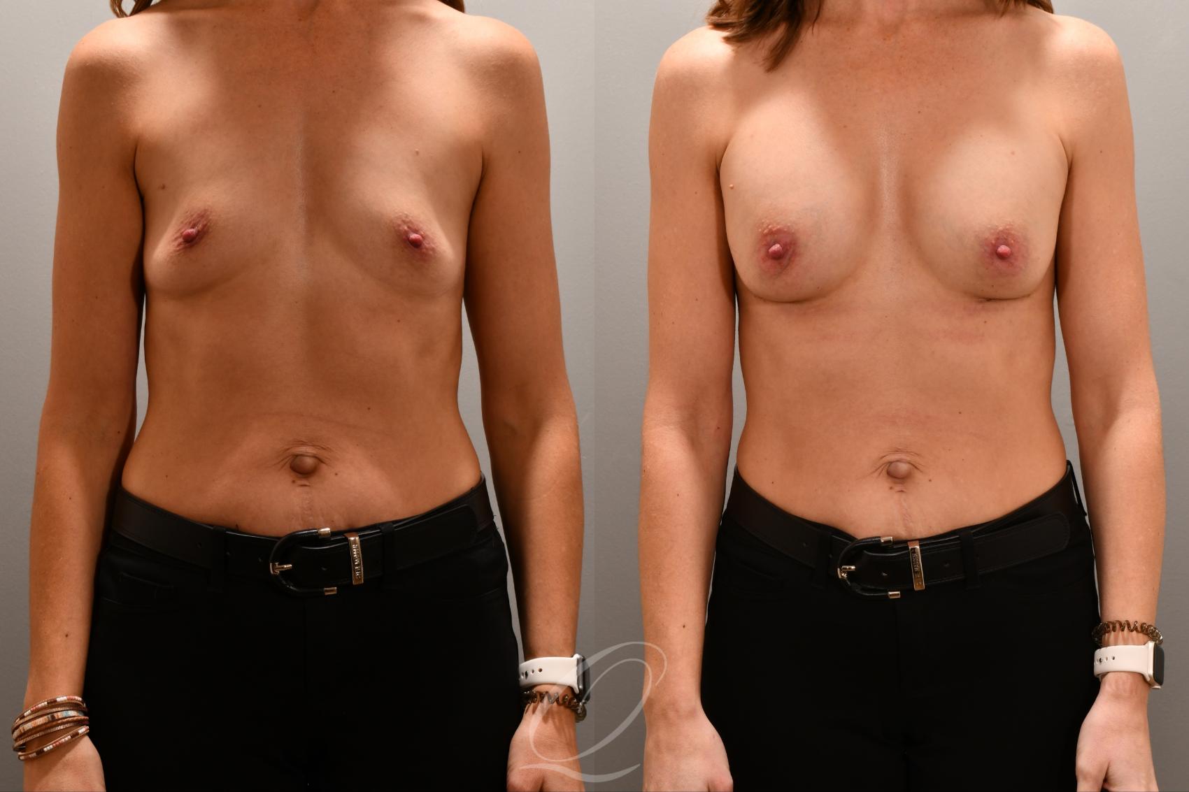 Breast Augmentation Case 1001806 Before & After Front | Serving Rochester, Syracuse & Buffalo, NY | Quatela Center for Plastic Surgery