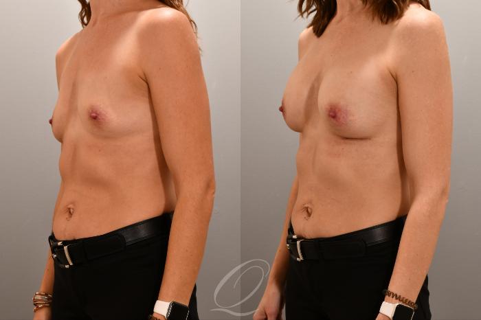 Breast Augmentation Case 1001806 Before & After Left Oblique | Serving Rochester, Syracuse & Buffalo, NY | Quatela Center for Plastic Surgery