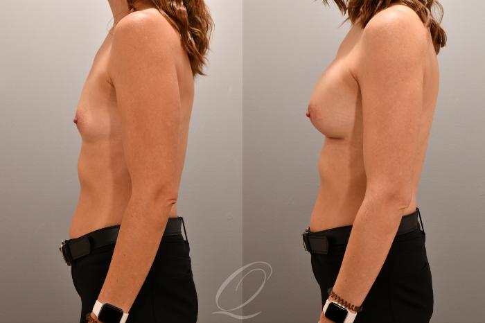 Breast Augmentation Case 1001806 Before & After Left Side | Serving Rochester, Syracuse & Buffalo, NY | Quatela Center for Plastic Surgery