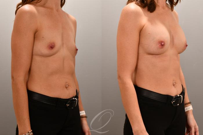 Breast Augmentation Case 1001806 Before & After Right Oblique | Serving Rochester, Syracuse & Buffalo, NY | Quatela Center for Plastic Surgery