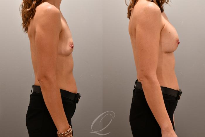 Breast Augmentation Case 1001806 Before & After Right Side | Serving Rochester, Syracuse & Buffalo, NY | Quatela Center for Plastic Surgery