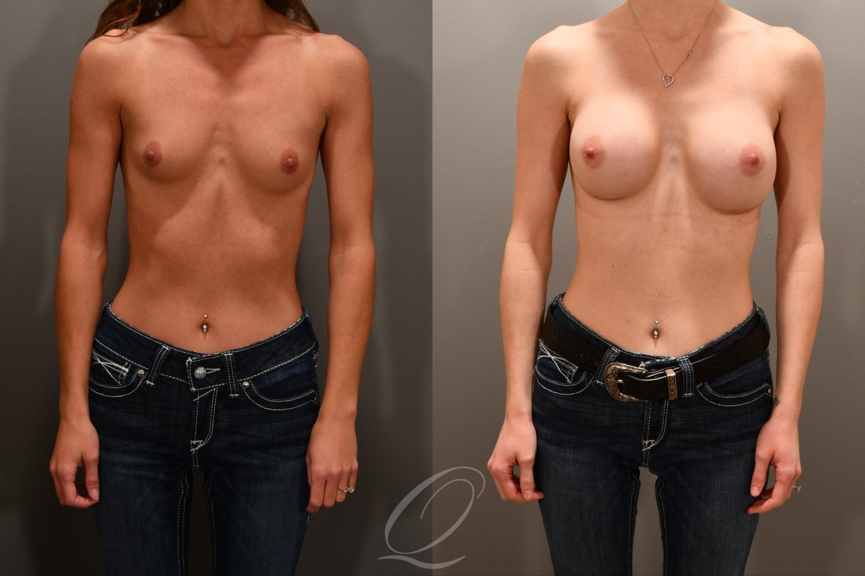 Breast Augmentation Case 1001854 Before & After Front | Serving Rochester, Syracuse & Buffalo, NY | Quatela Center for Plastic Surgery