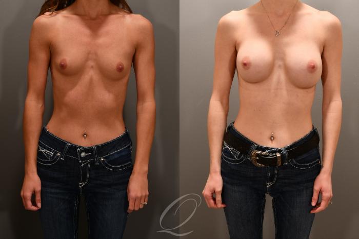 Breast Augmentation Case 1001854 Before & After Front | Serving Rochester, Syracuse & Buffalo, NY | Quatela Center for Plastic Surgery