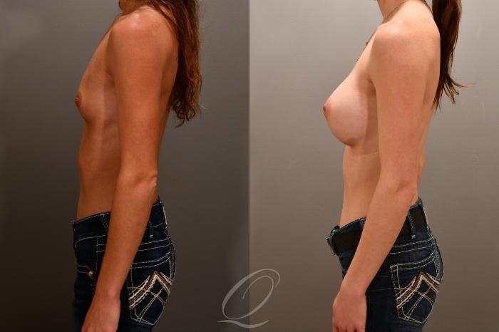 Breast Augmentation Case 1001854 Before & After Left Side | Serving Rochester, Syracuse & Buffalo, NY | Quatela Center for Plastic Surgery