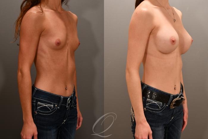 Breast Augmentation Case 1001854 Before & After Right Oblique | Serving Rochester, Syracuse & Buffalo, NY | Quatela Center for Plastic Surgery