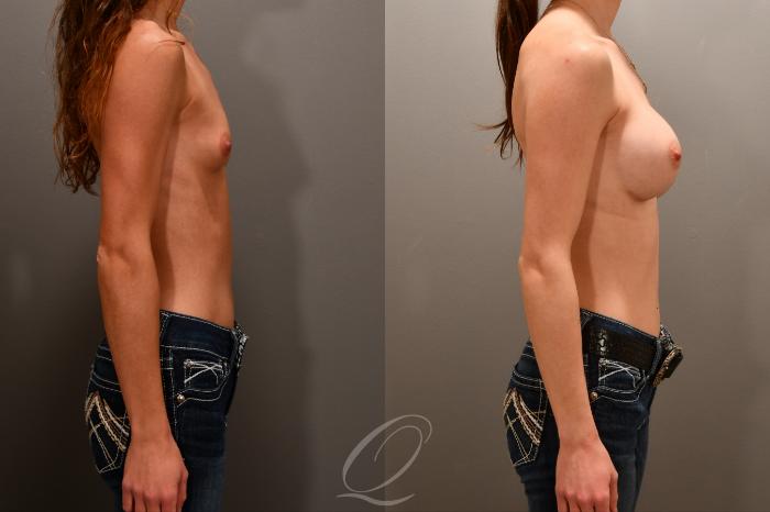 Breast Augmentation Case 1001854 Before & After Right Side | Serving Rochester, Syracuse & Buffalo, NY | Quatela Center for Plastic Surgery