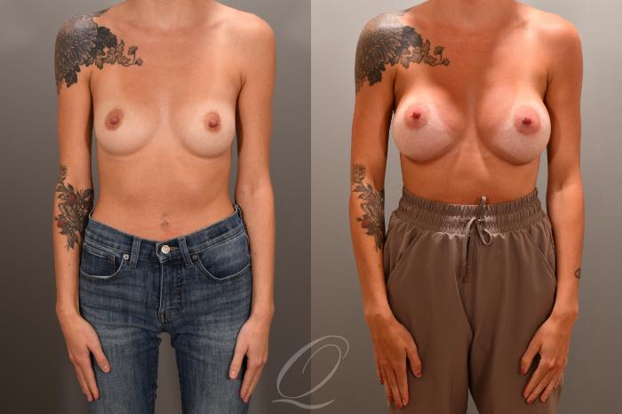 Breast Augmentation Case 1001866 Before & After Front | Serving Rochester, Syracuse & Buffalo, NY | Quatela Center for Plastic Surgery