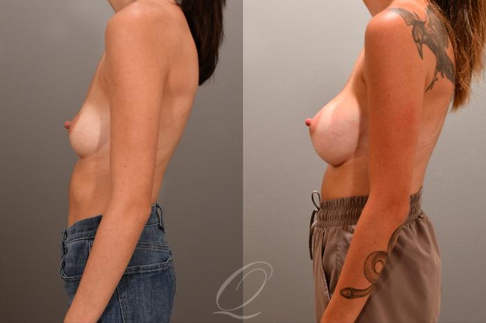 Breast Augmentation Case 1001866 Before & After Left Side | Serving Rochester, Syracuse & Buffalo, NY | Quatela Center for Plastic Surgery