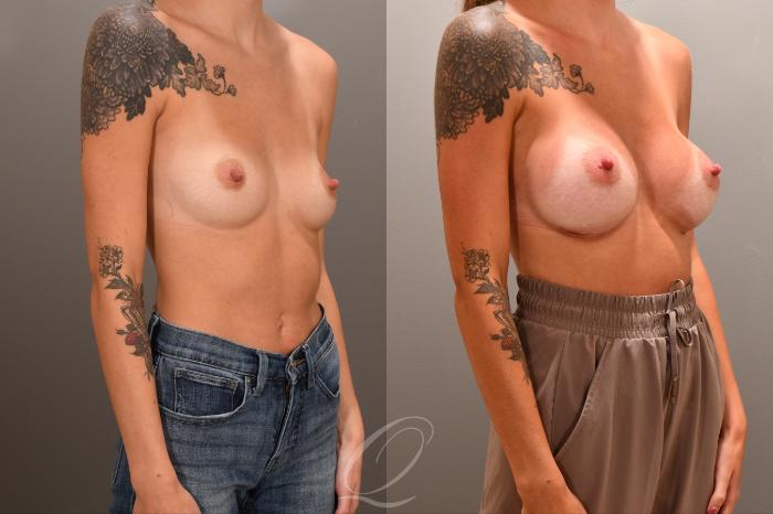 Breast Augmentation Case 1001866 Before & After Right Oblique | Serving Rochester, Syracuse & Buffalo, NY | Quatela Center for Plastic Surgery