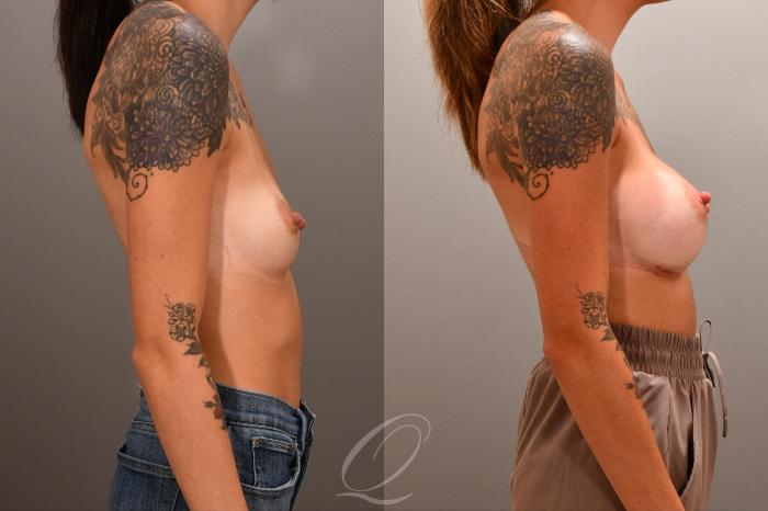 Breast Augmentation Case 1001866 Before & After Right Side | Serving Rochester, Syracuse & Buffalo, NY | Quatela Center for Plastic Surgery