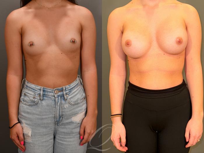 Breast Augmentation Case 1001867 Before & After Front | Serving Rochester, Syracuse & Buffalo, NY | Quatela Center for Plastic Surgery