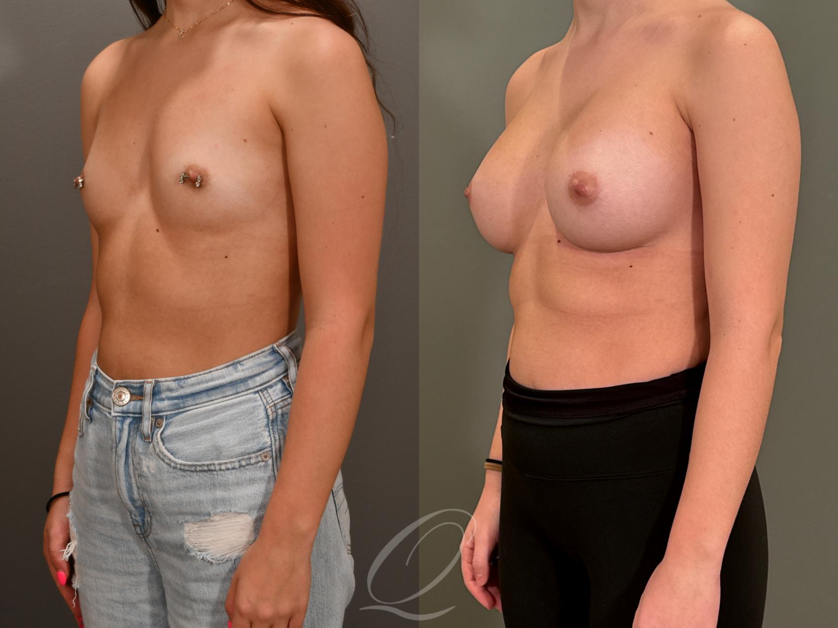 Breast Augmentation Case 1001867 Before & After Left Oblique | Serving Rochester, Syracuse & Buffalo, NY | Quatela Center for Plastic Surgery