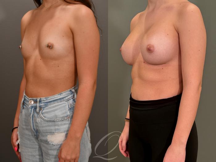 Breast Augmentation Case 1001867 Before & After Left Oblique | Serving Rochester, Syracuse & Buffalo, NY | Quatela Center for Plastic Surgery