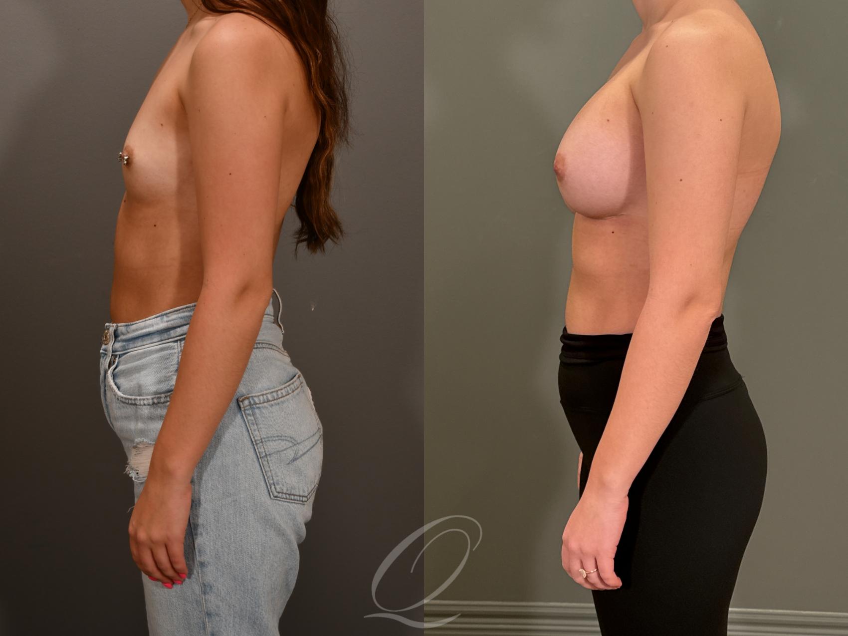 Breast Augmentation Case 1001867 Before & After Left Side | Serving Rochester, Syracuse & Buffalo, NY | Quatela Center for Plastic Surgery