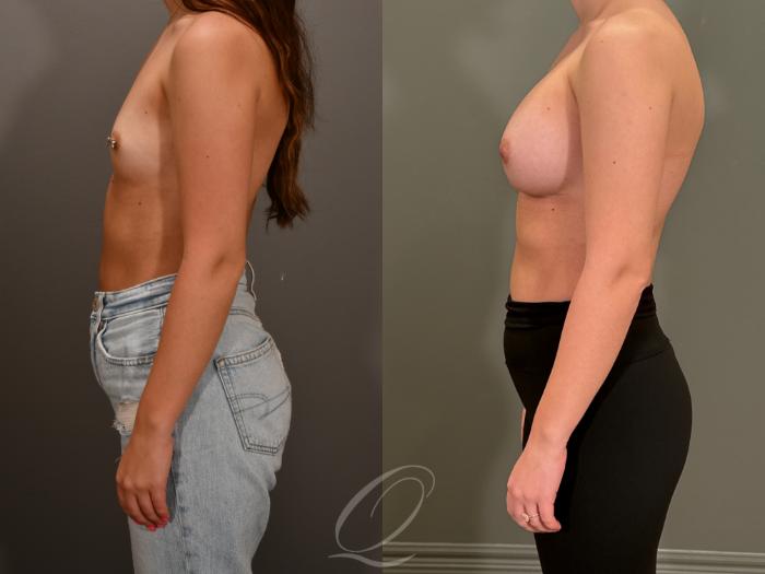 Breast Augmentation Case 1001867 Before & After Left Side | Serving Rochester, Syracuse & Buffalo, NY | Quatela Center for Plastic Surgery