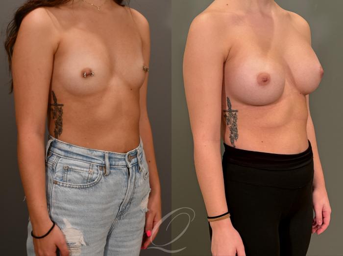 Breast Augmentation Case 1001867 Before & After Right Oblique | Serving Rochester, Syracuse & Buffalo, NY | Quatela Center for Plastic Surgery